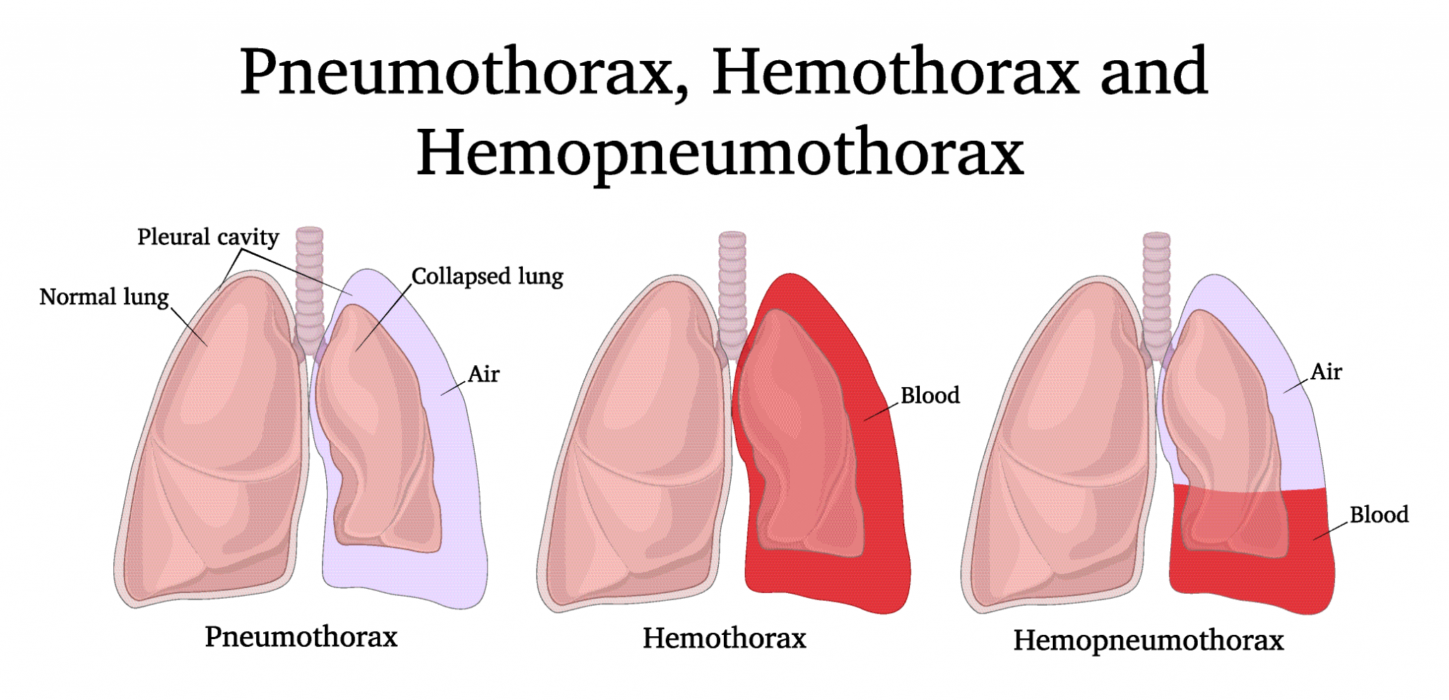 Thoracic Trauma - Pneumothorax Copy - High Peak First Aid